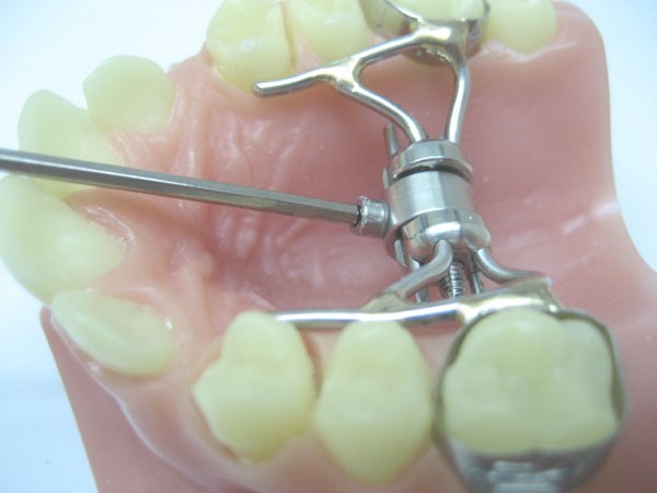 VECS palate expander